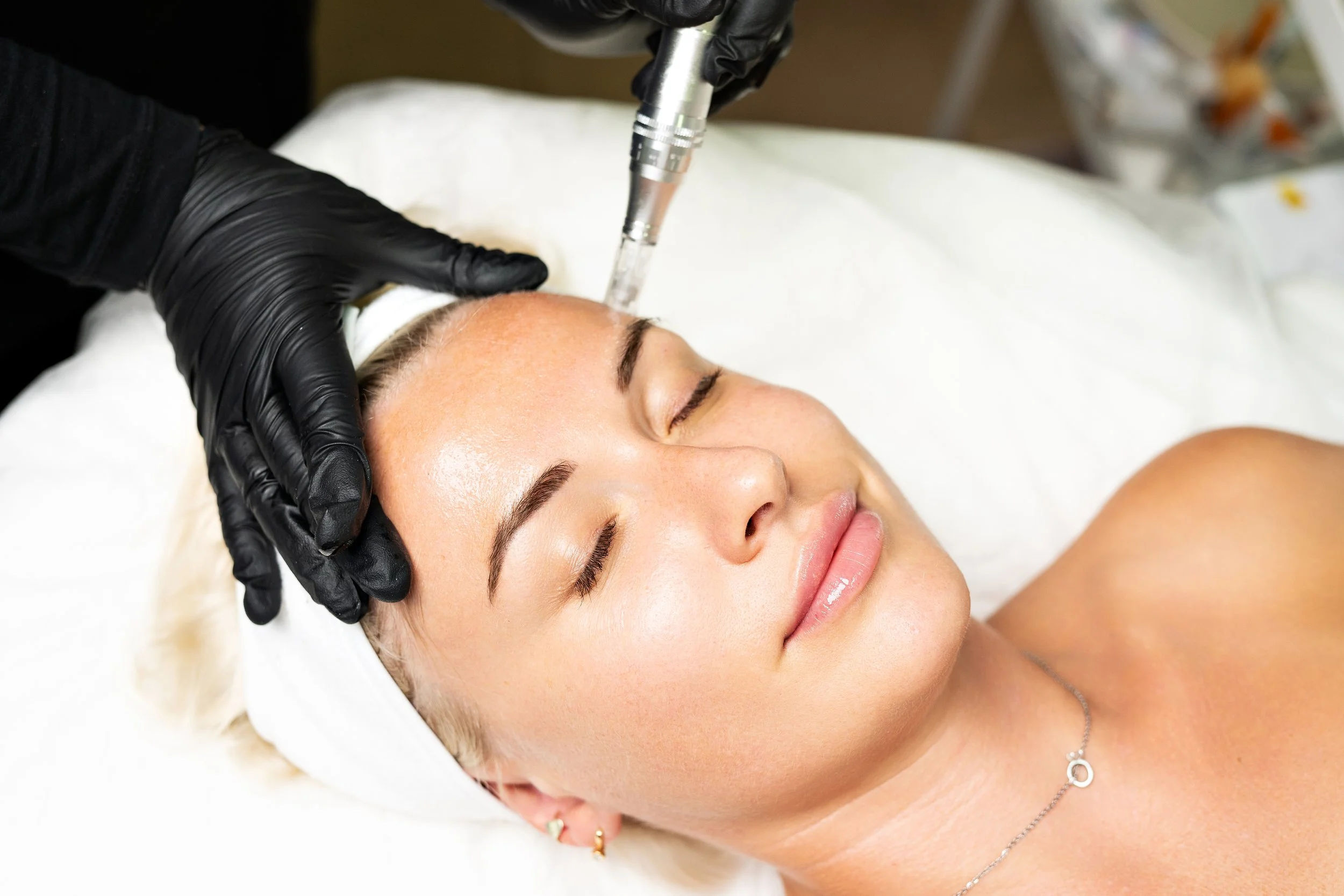 Microneedling collagen induction therapy treatment being performed on a patient's face at Point Acupuncture in Portland, Maine