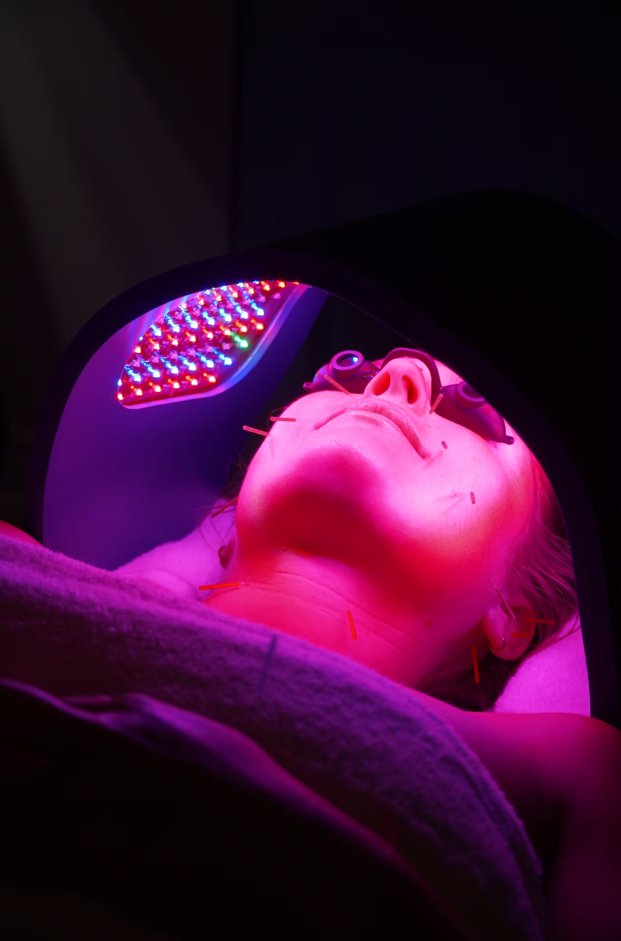 Close-up of acupuncture needles inserted into a patient's back during a bodywork session at Point Acupuncture in Portland, Maine