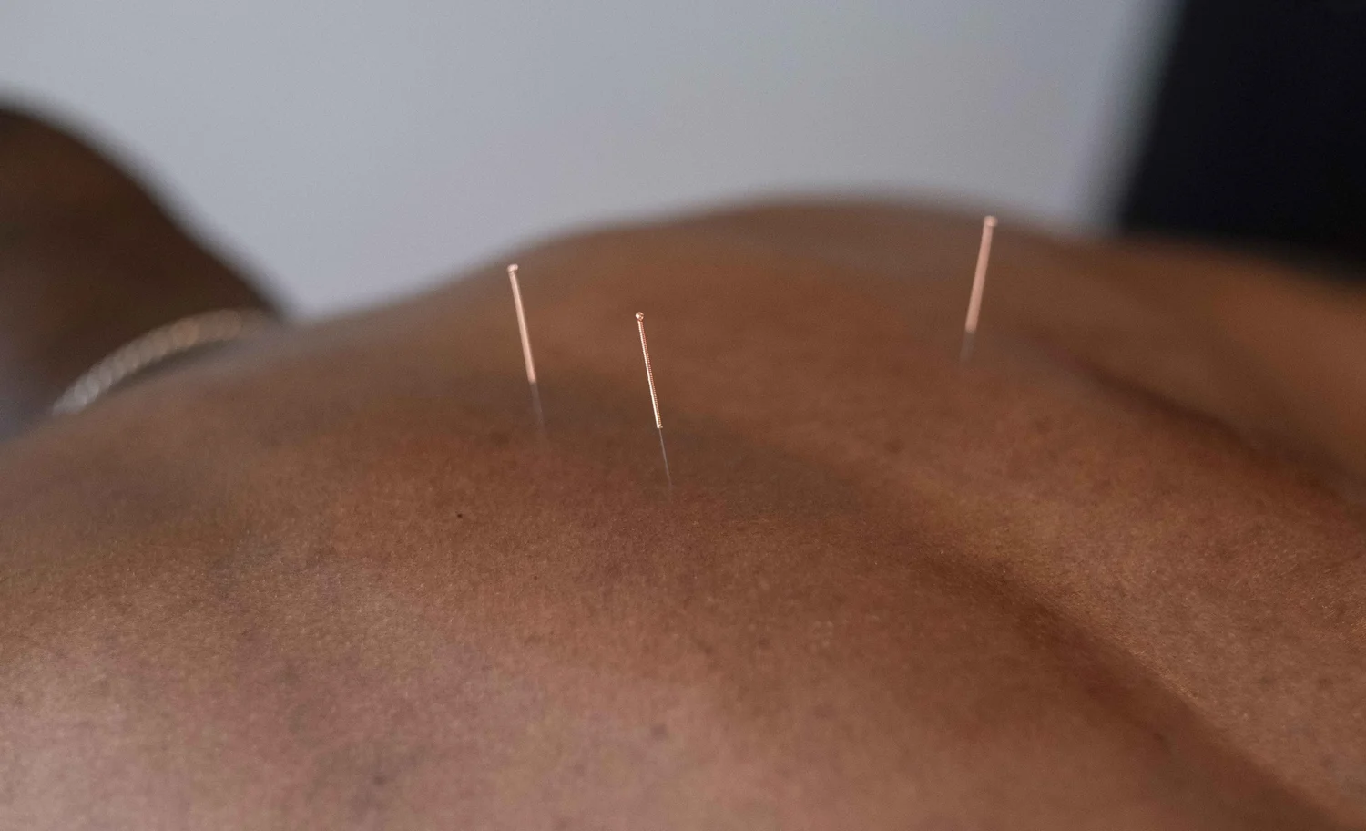 Dry needling therapy for musculoskeletal pain relief at Point Acupuncture in Portland, Maine